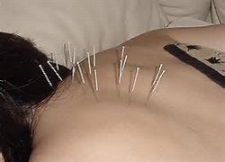 acupunturist-acupuncture-treatment-pain-brisbane-northside-6
