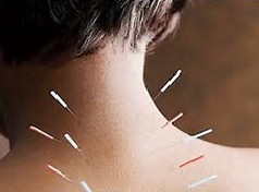 acupunturist-acupuncture-treatment-pain-brisbane-northside