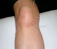 knee Osteoarthritis-acupunctue-brisbane-northside-2