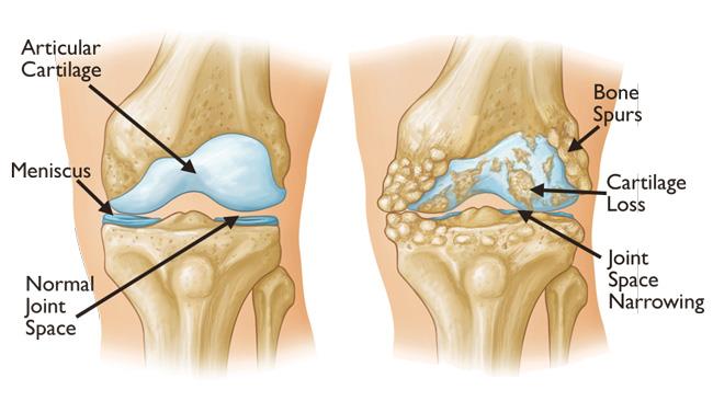 knee-pain-treatment-brisbane-northside-ashgrove-qld-au-1