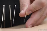 repetitive-strain-injuries-treatments-acupuncture-brisbane-northside-11